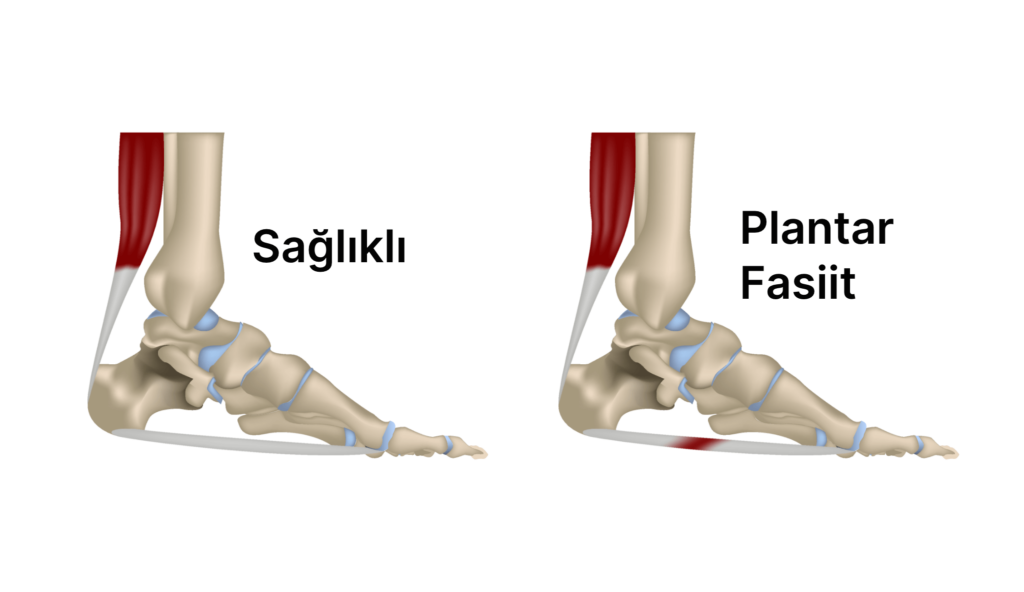 Plantar fasiit ve sağlıklı bir ayağın anatomik farklılıkları